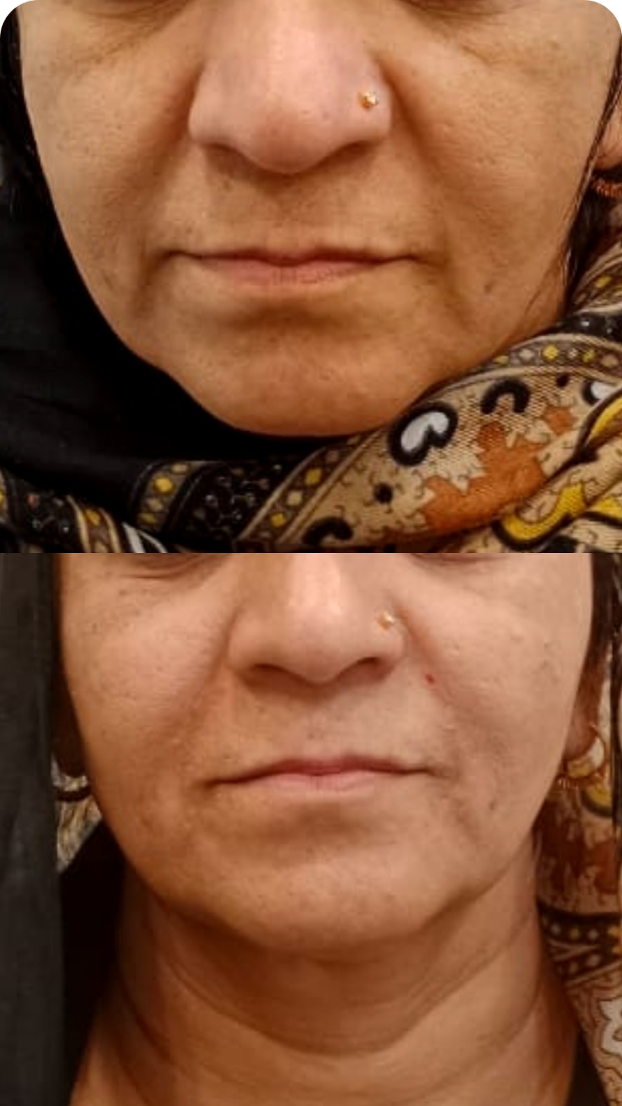 Face Fillers