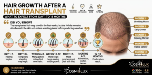 hair transplant Growth